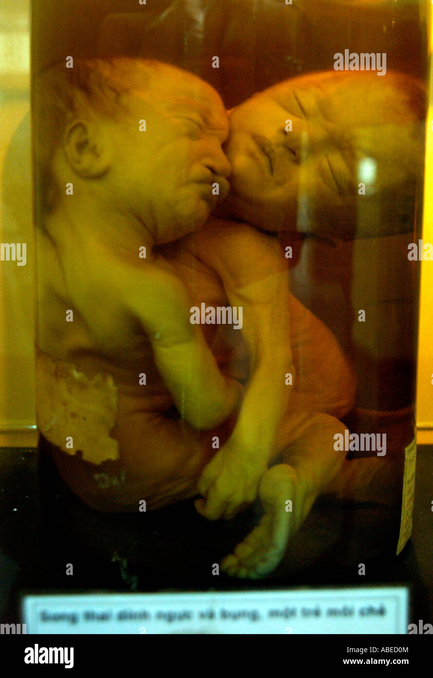 A deformed foetus is preserved in the War Crimes Museum in Ho Chi Minh City Vietnam Stock Photo