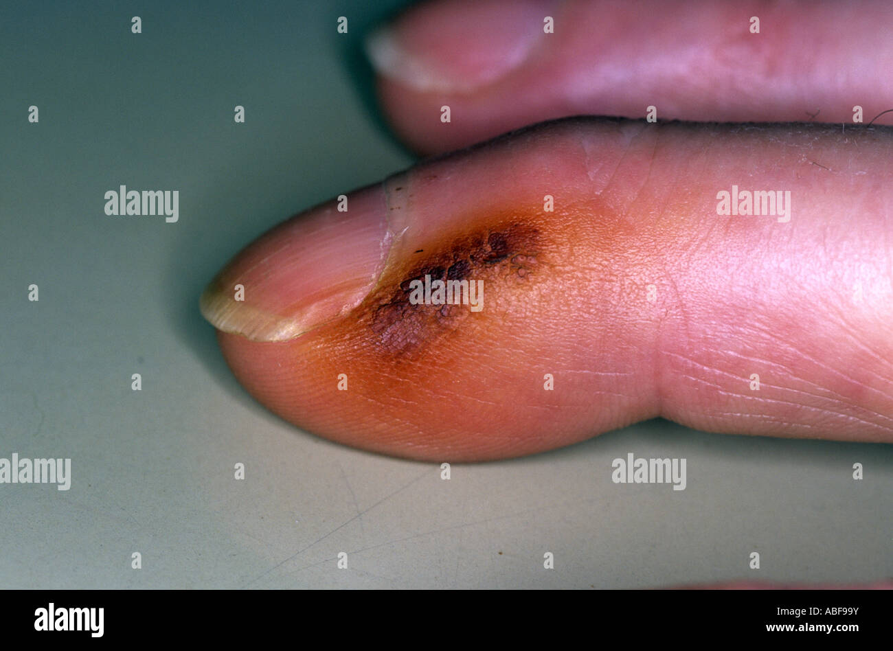 Finger clubbing hires stock photography and images Alamy