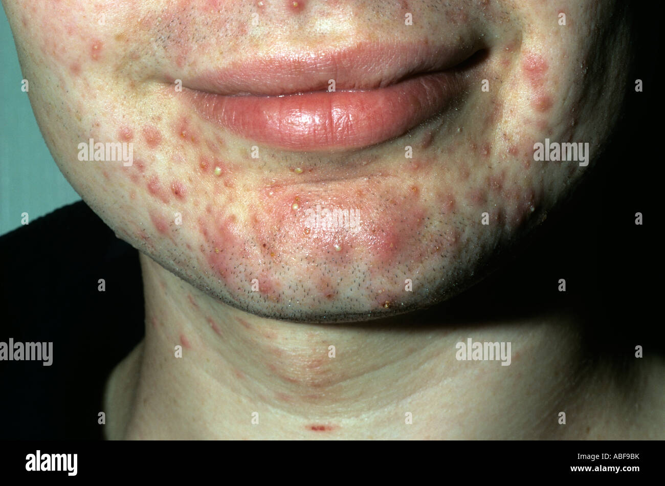 For acne hires stock photography and images Alamy