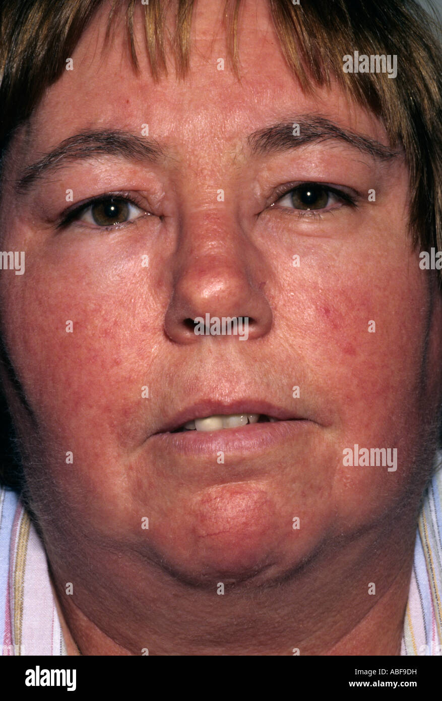 Allergic Reaction Around Eyes