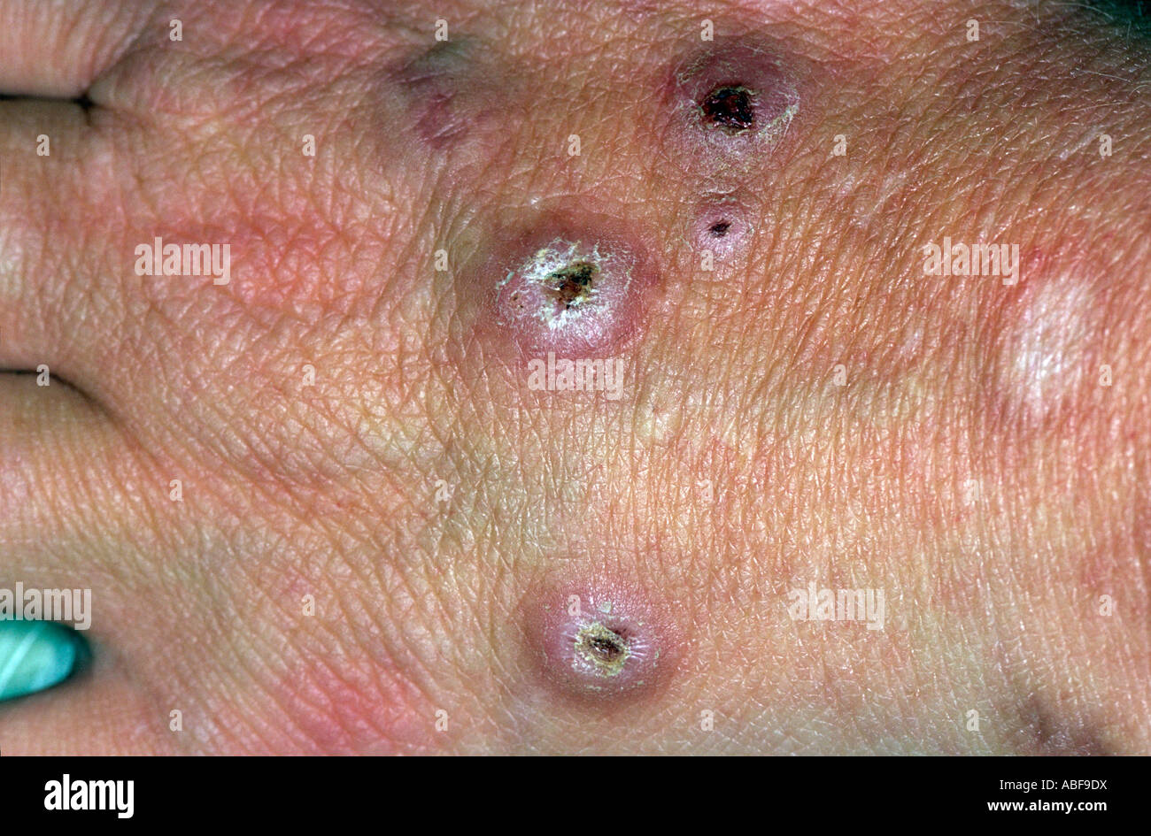 Nodular prurigo hi-res stock photography and images - Alamy