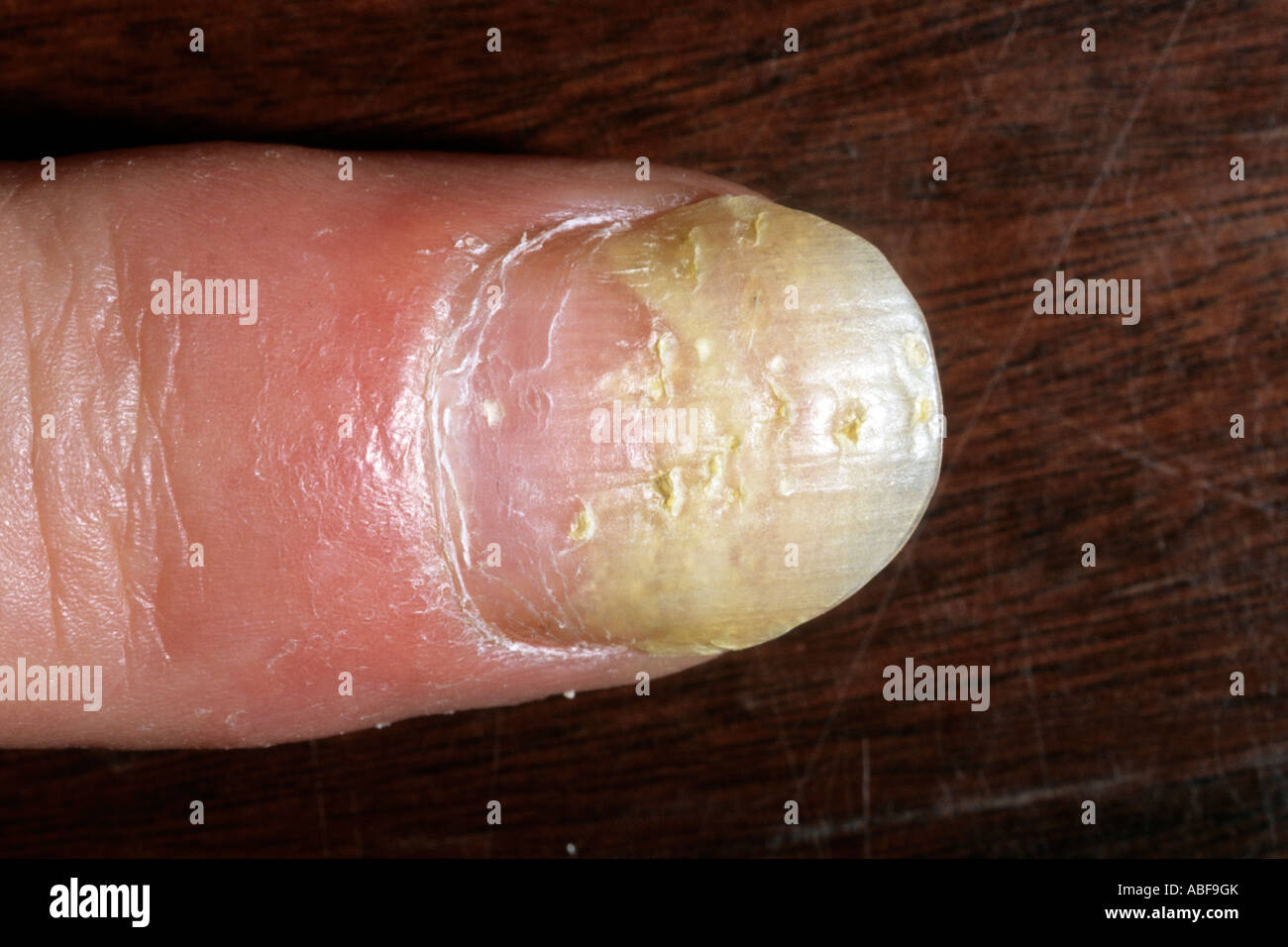 psoriasis affecting the nail showing pitting & onychlysis Stock Photo