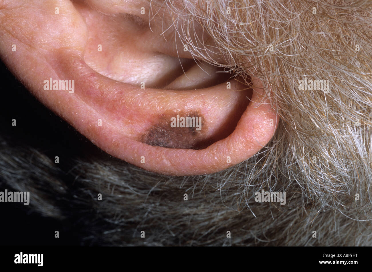 Of naevus hi-res stock photography and images - Alamy