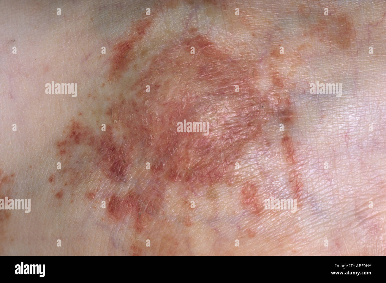 rash of varicose eczema with inflammation scaling & brown discolouration. It is associated with venous insuffiency Stock Photo
