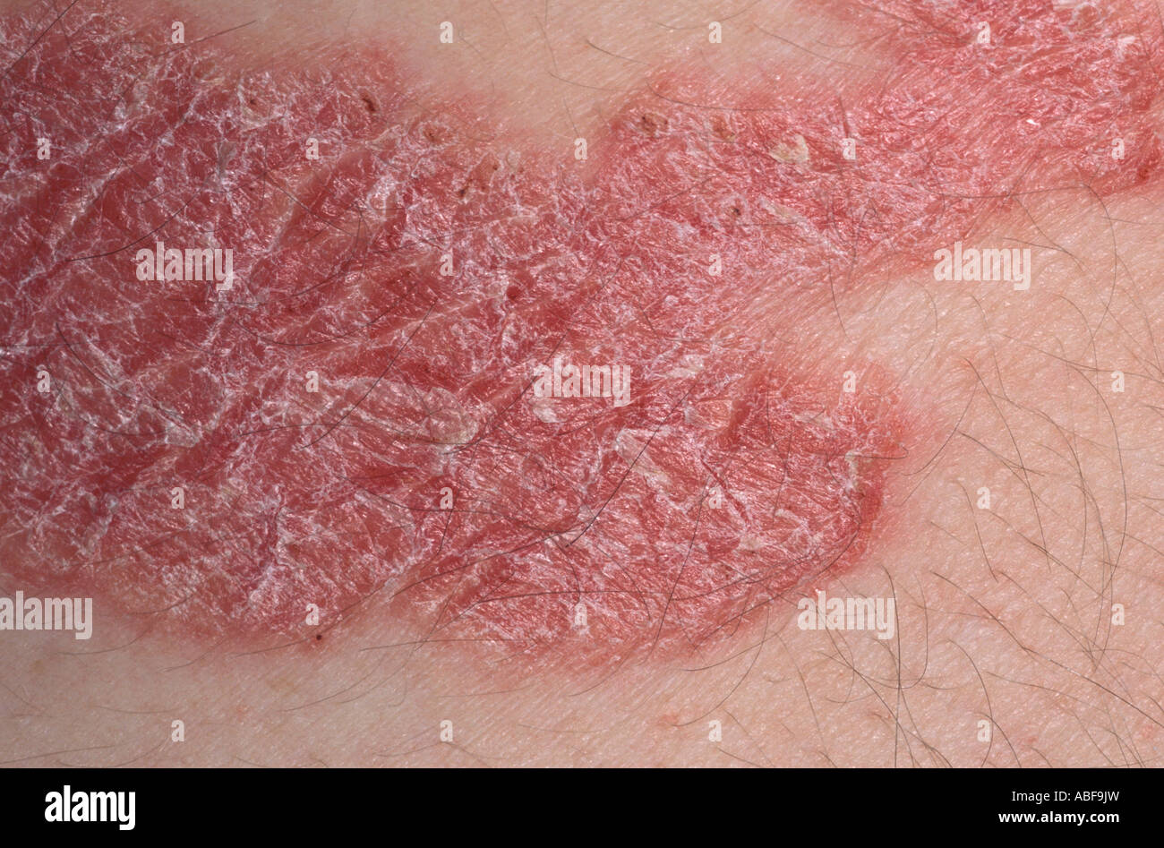 Typical lesion of psoriasis with demarcated edge & profuse scale Stock