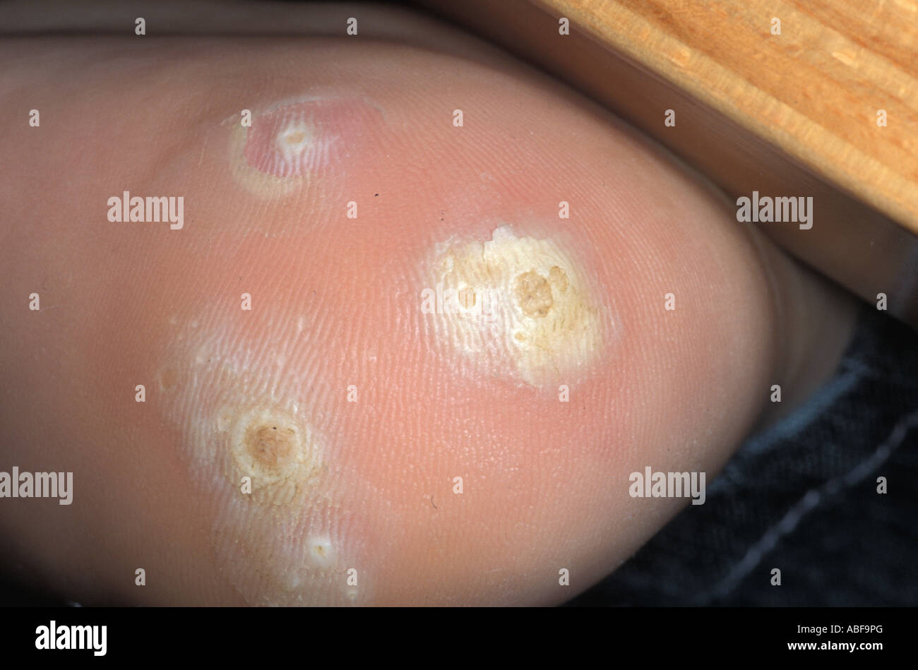 Human Papillomavirus Stock Photos &amp; Human Papillomavirus