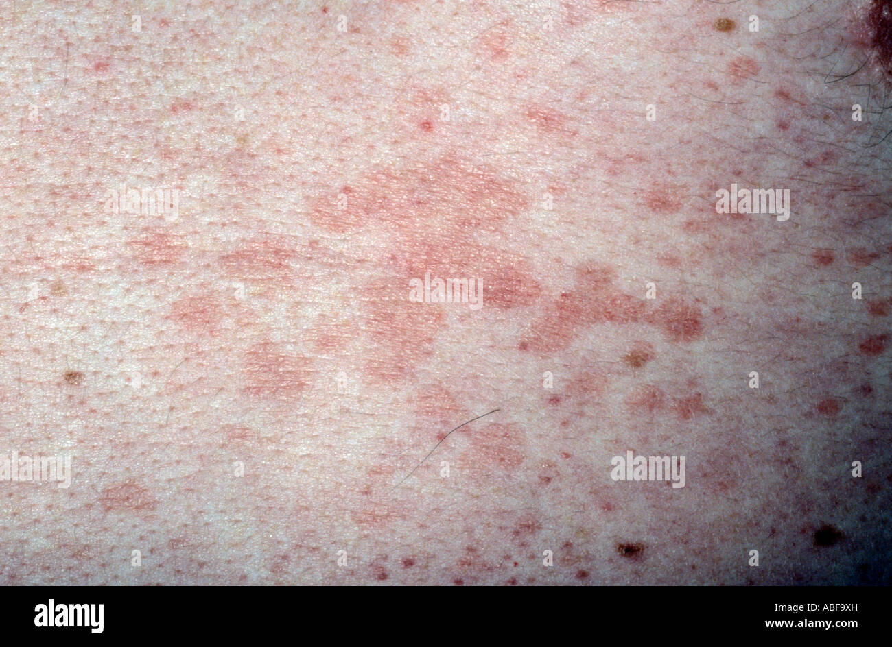The rash of pityriasis rosea, a human herpes virus 7 (HHV7 Stock Photo ...