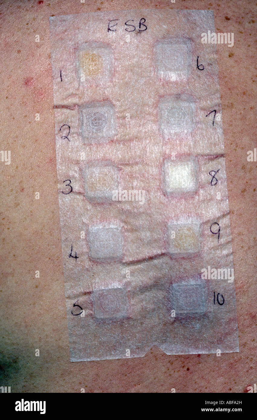 Dermatits hi-res stock photography and images - Alamy