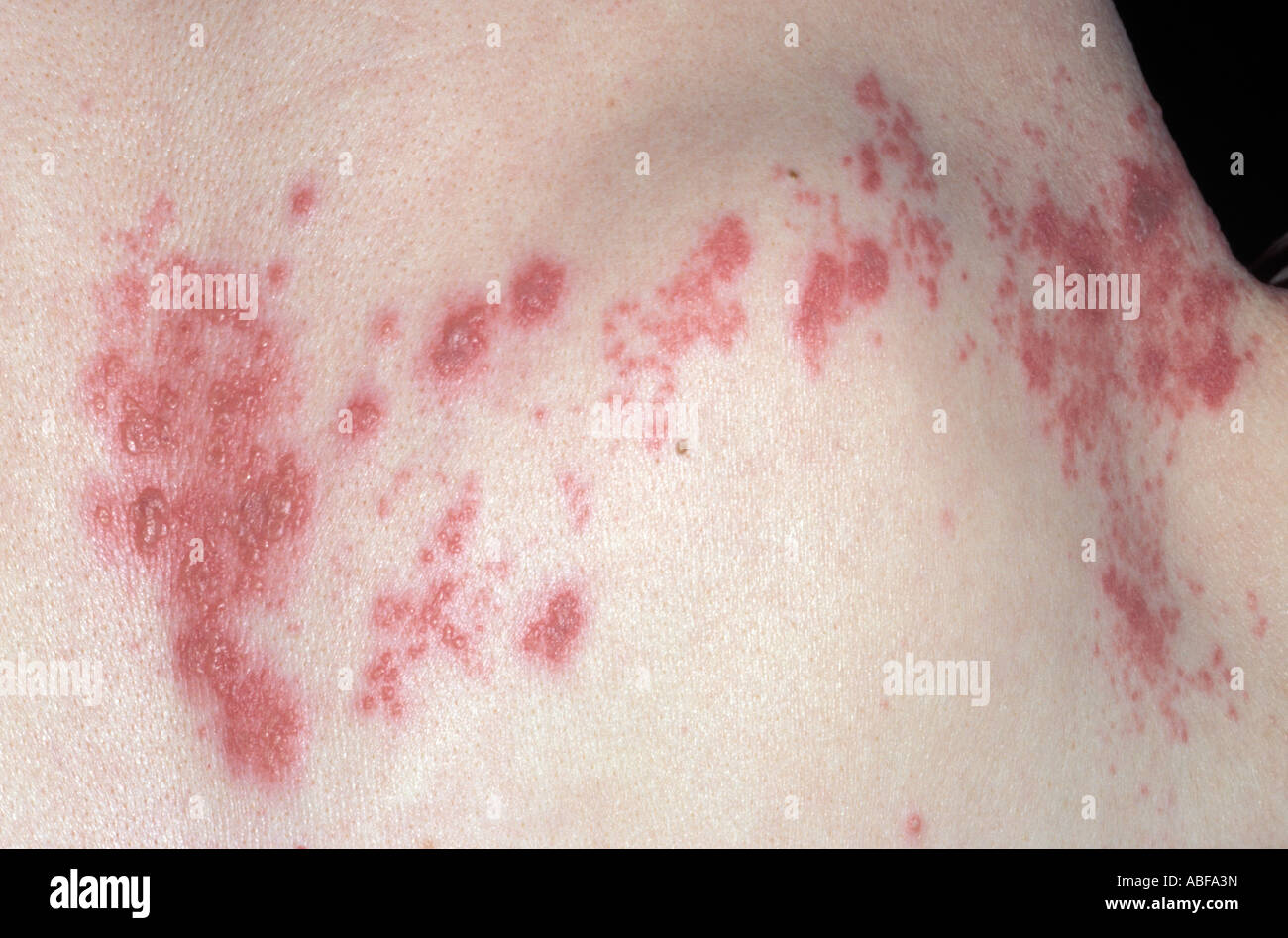 Dermatome hires stock photography and images Alamy