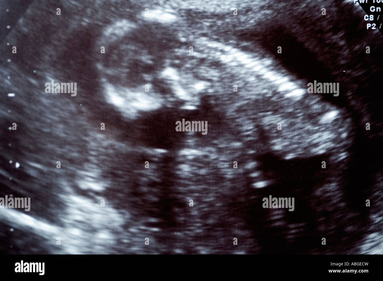 Scan of foetus aged 12 weeks old Stock Photo