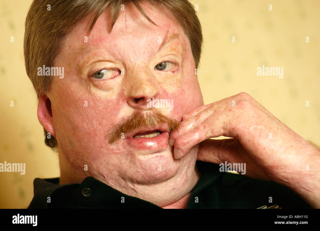 Simon Weston suffered terrible burns when RFA Sir Galahad was bombed during Falklands war 1982 while serving with Welsh Guards Stock Photo