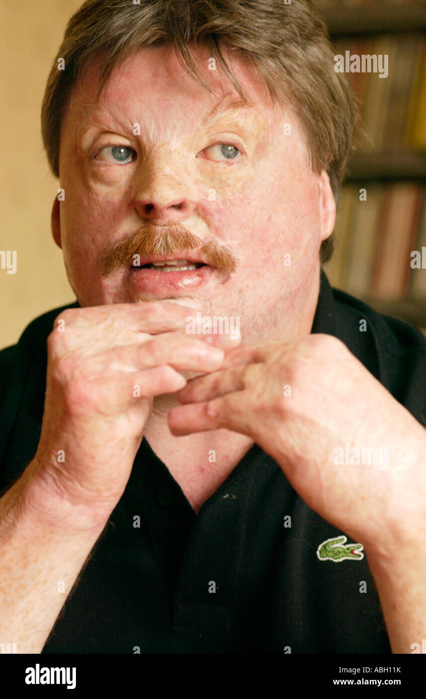 Simon Weston suffered terrible burns when RFA Sir Galahad was bombed