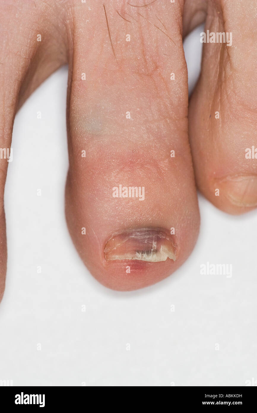 Stubbed toe with bruise and broken nail toenail Stock Photo Alamy