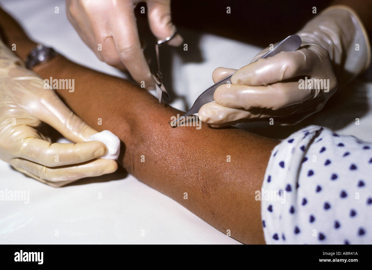 Manaus, Brazil. Doctor wearing surgicial rubber gloves taking as sample from patient with Hansen's disease. Amazonas State. Stock Photo