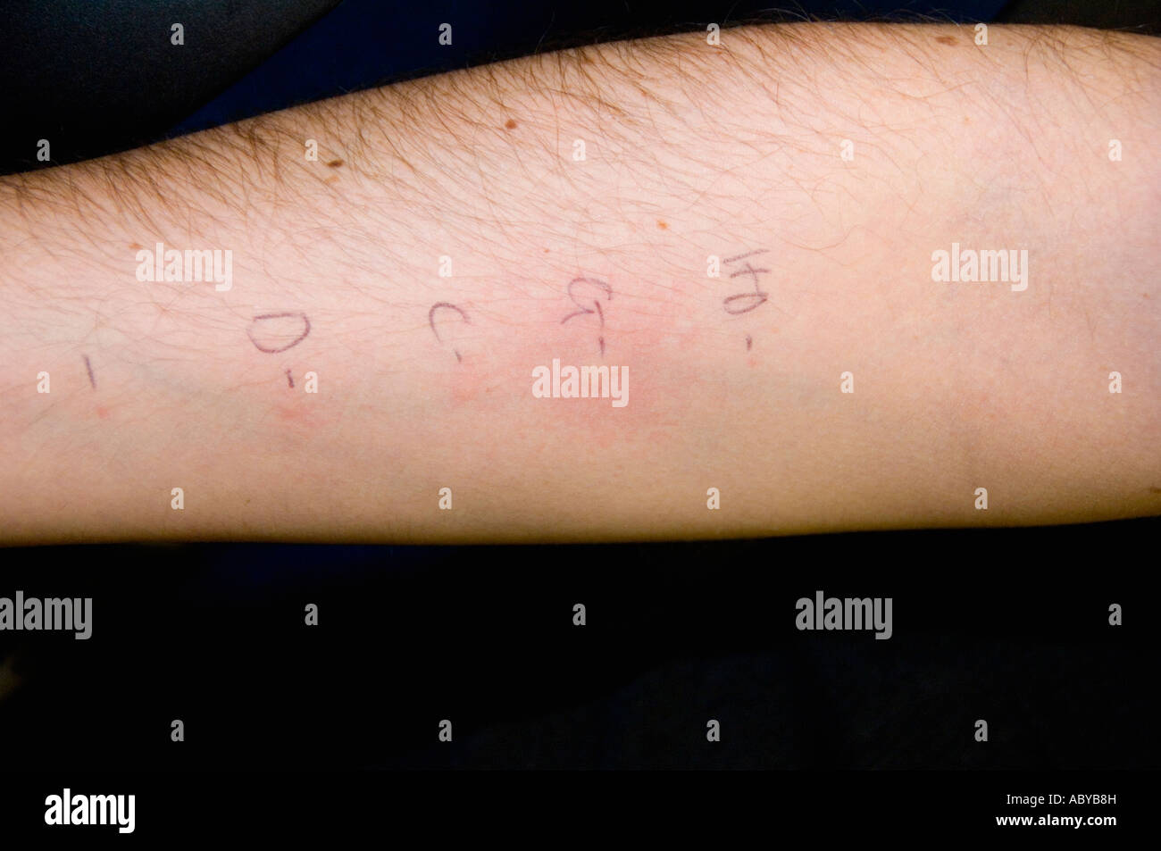 Performing Skin Prick Test For Diagnosis Of Atopy And Allergy Stock Photo Alamy