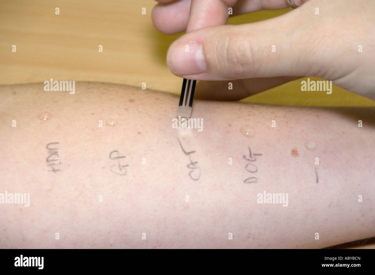 Performing Skin prick test for diagnosis of atopy and allergy Stock ...