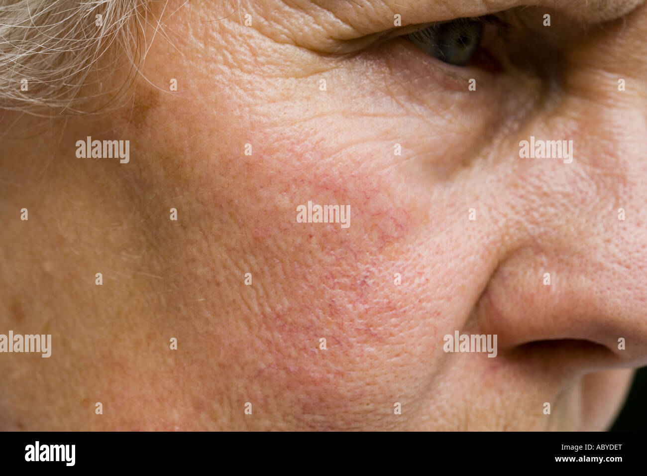 Superficial Veins Hi-res Stock Photography And Images - Alamy