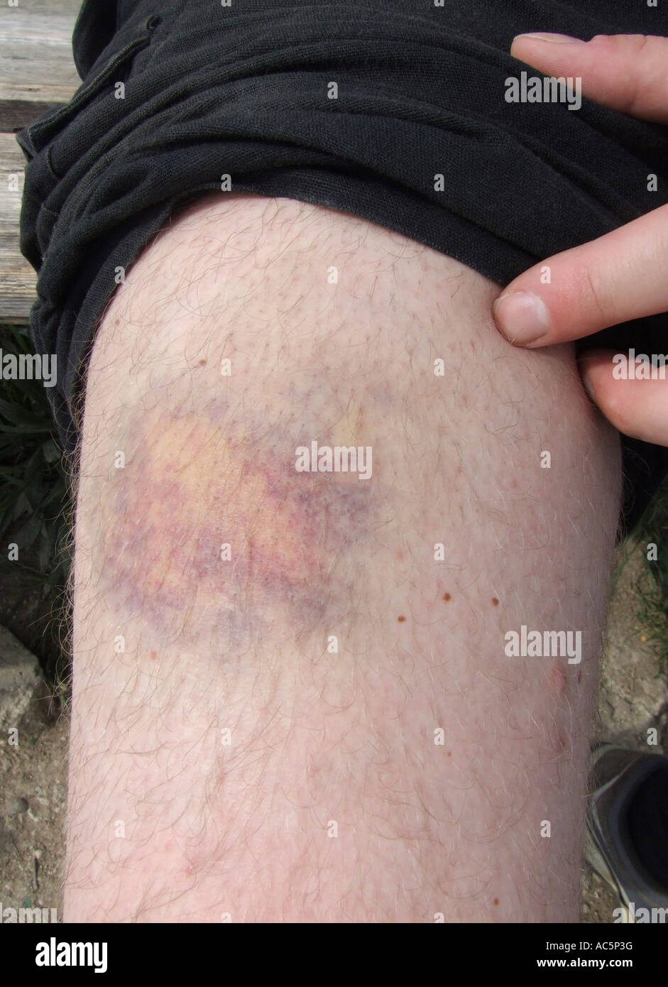 Injured leg close up Stock Photo