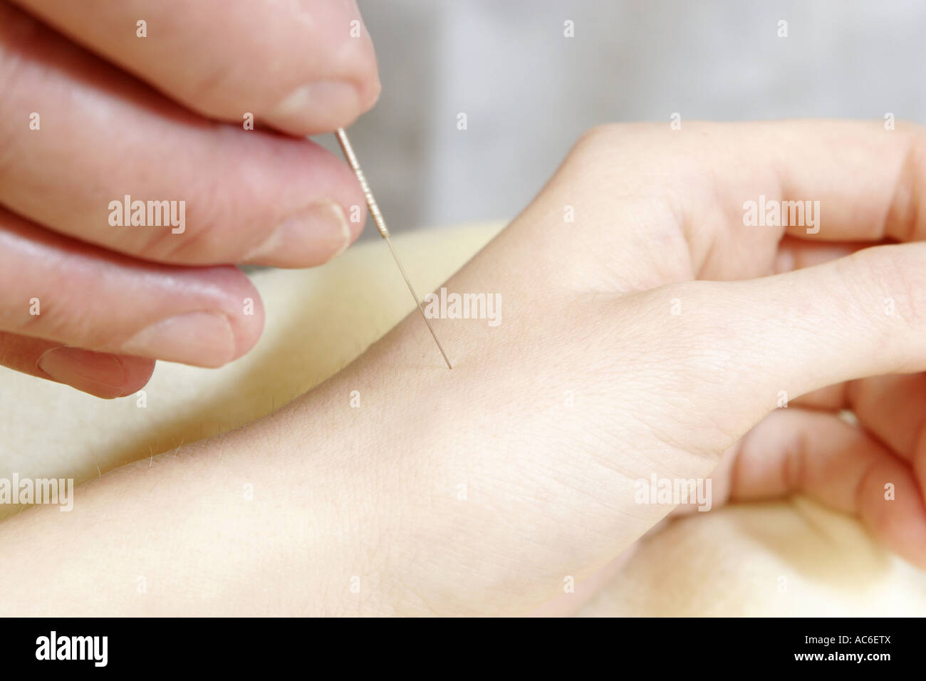 Inserting of acupuncture needle to the hand Stock Photo Alamy