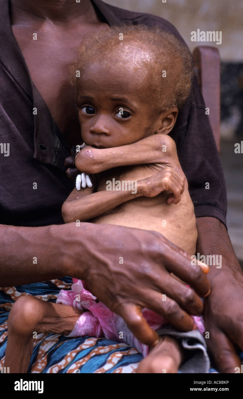 Sierra Leone 1999 Victims of war Severely malnourished baby Stock Photo