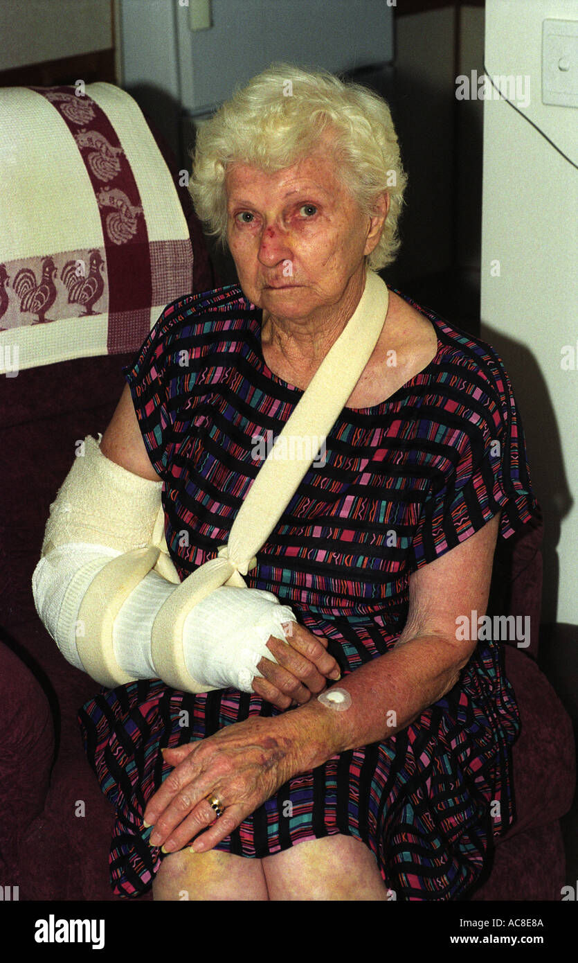 Bruised elbow hires stock photography and images Alamy