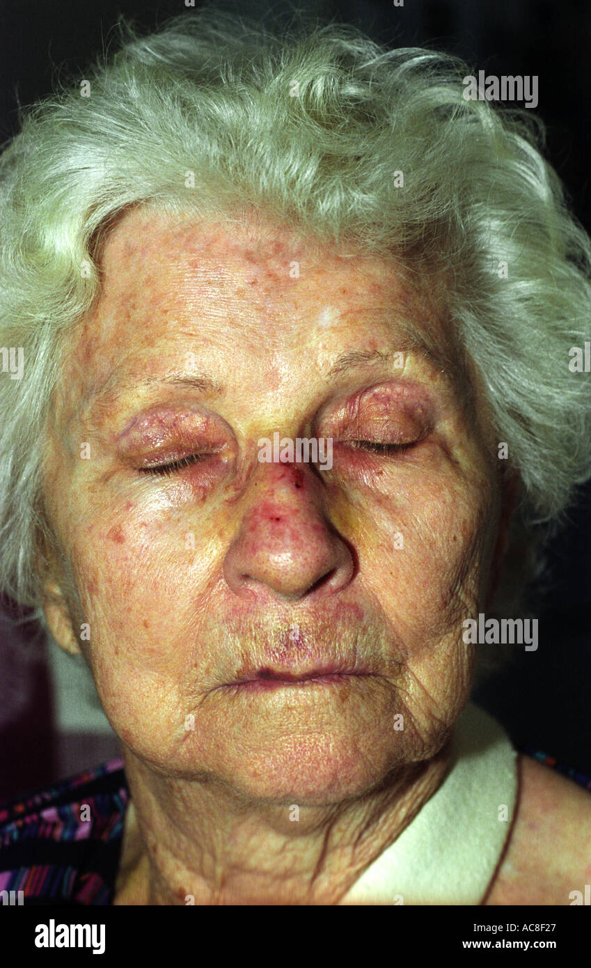 Bruised face hi-res stock photography and images - Alamy