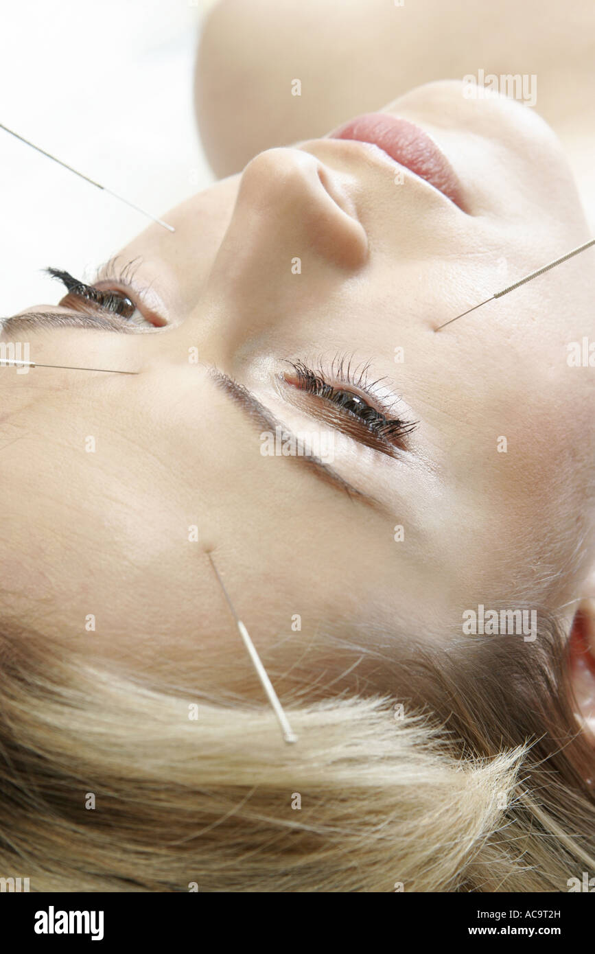 Acupuncture needles in the face Stock Photo Alamy