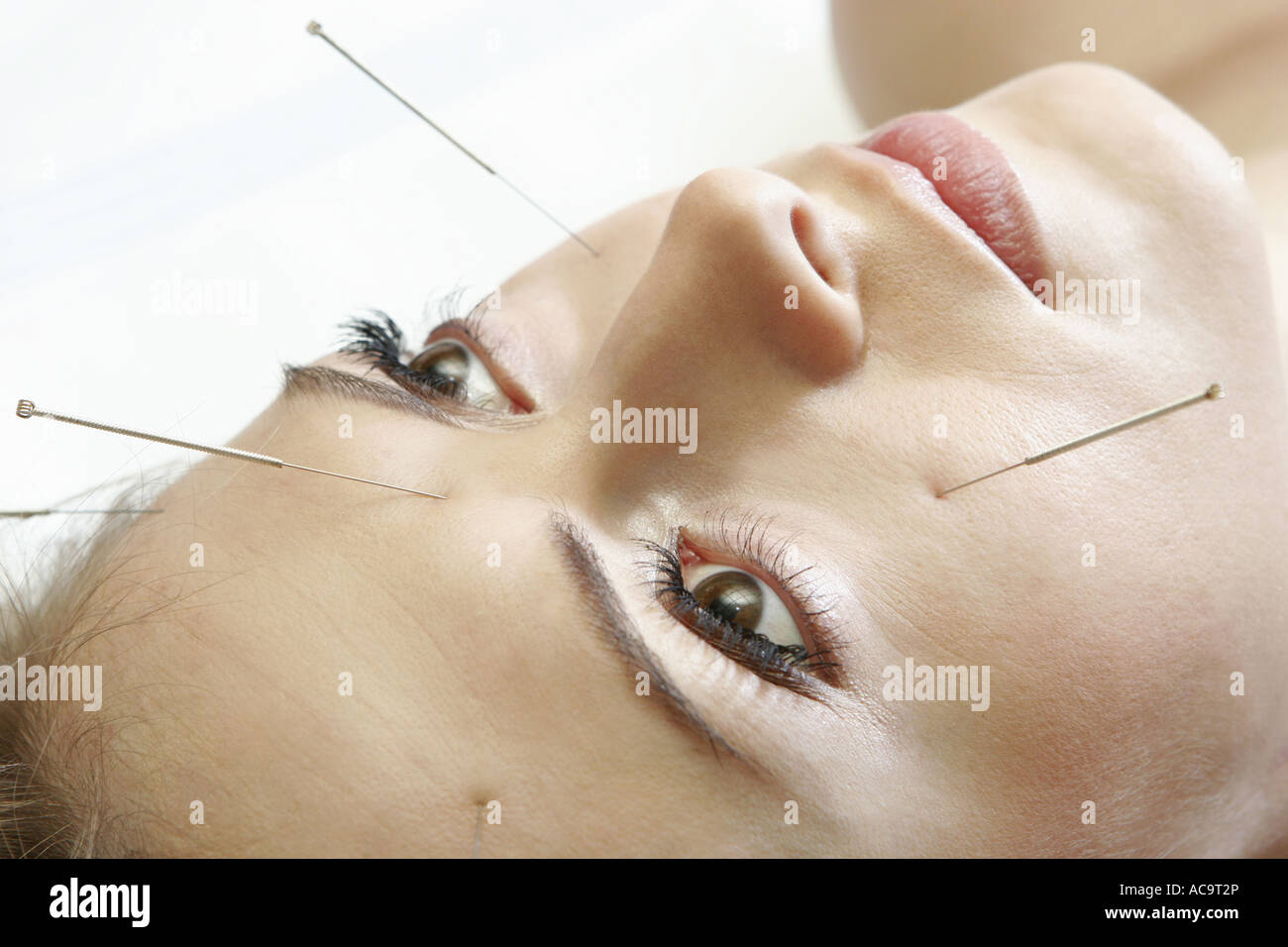 Acupuncture needles in the face Stock Photo Alamy