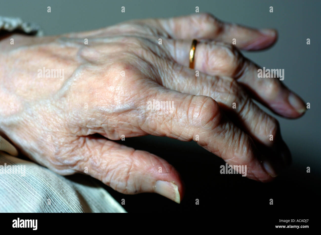 Rheumatoid arthritis hands hires stock photography and images Alamy