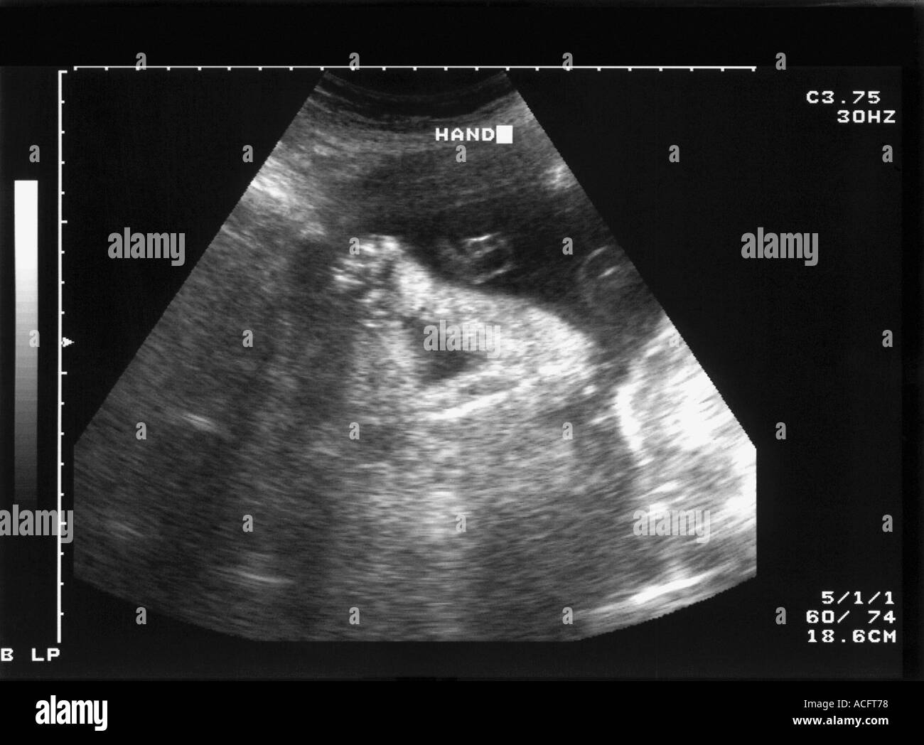Tiny ultrasound Black and White Stock Photos & Images - Alamy