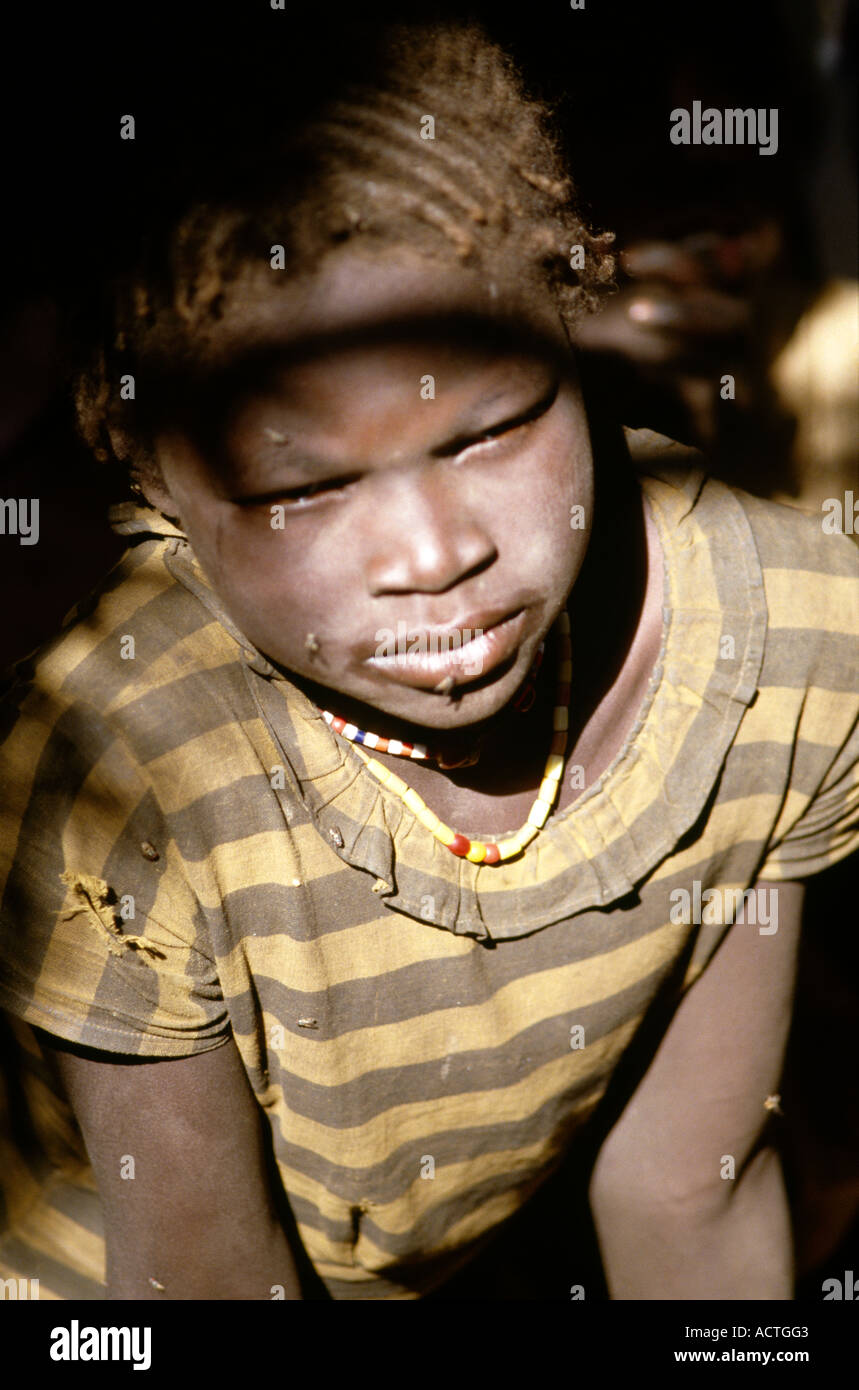 Sudan Sinnar Camp Child with Kwashiorkor Stock Photo