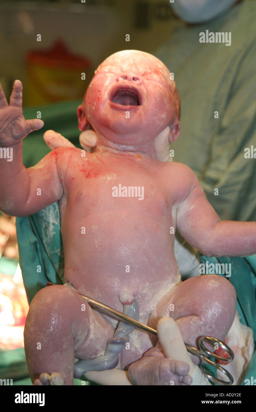 caesarian section delivery Stock Photo