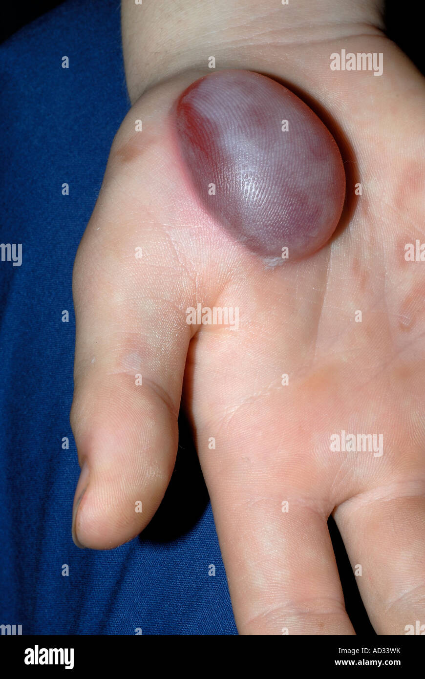 burn blister on the hand of a young boy Stock Photo