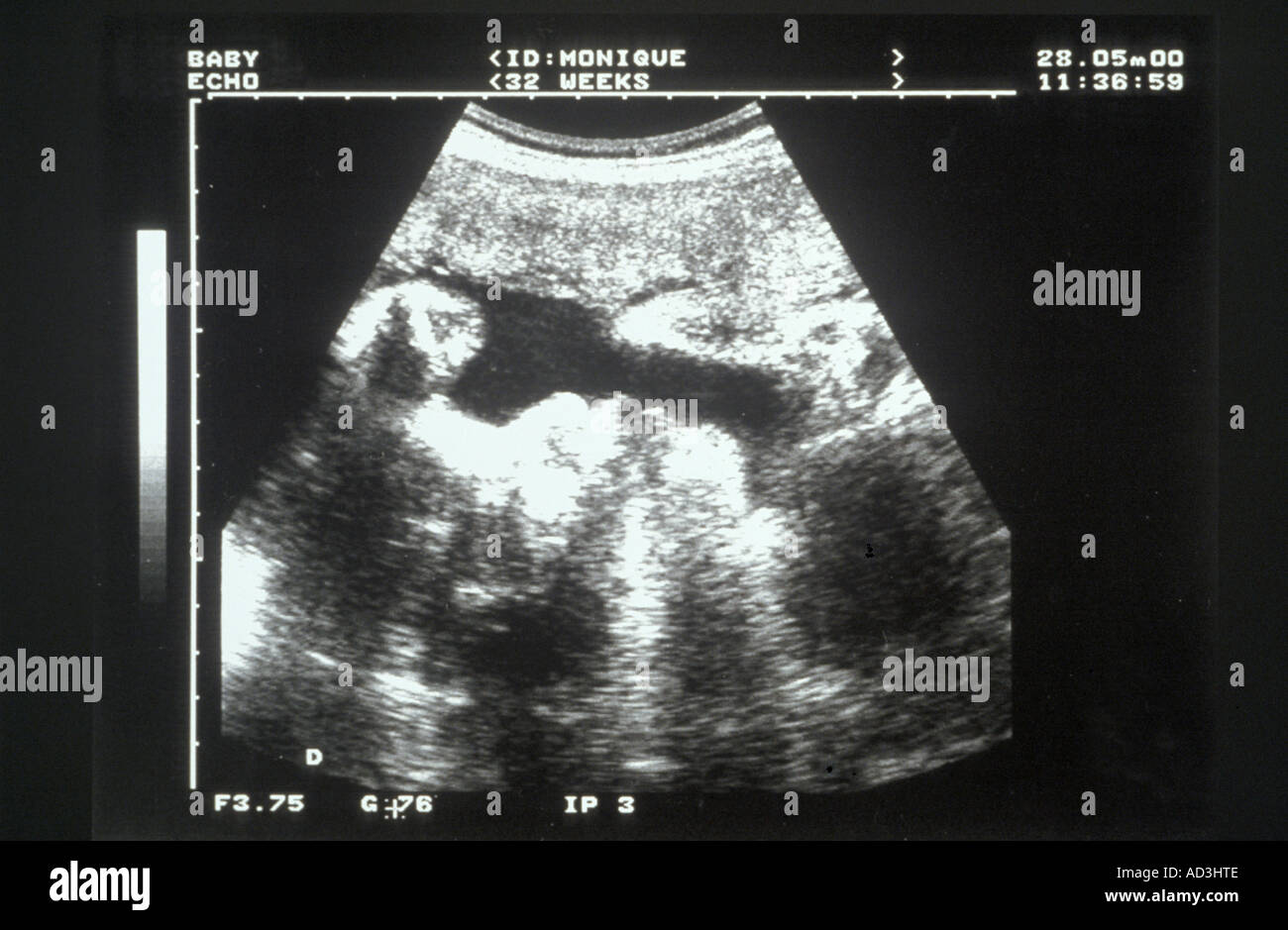 Ultrasound photography hi-res stock photography and images - Page 3 - Alamy