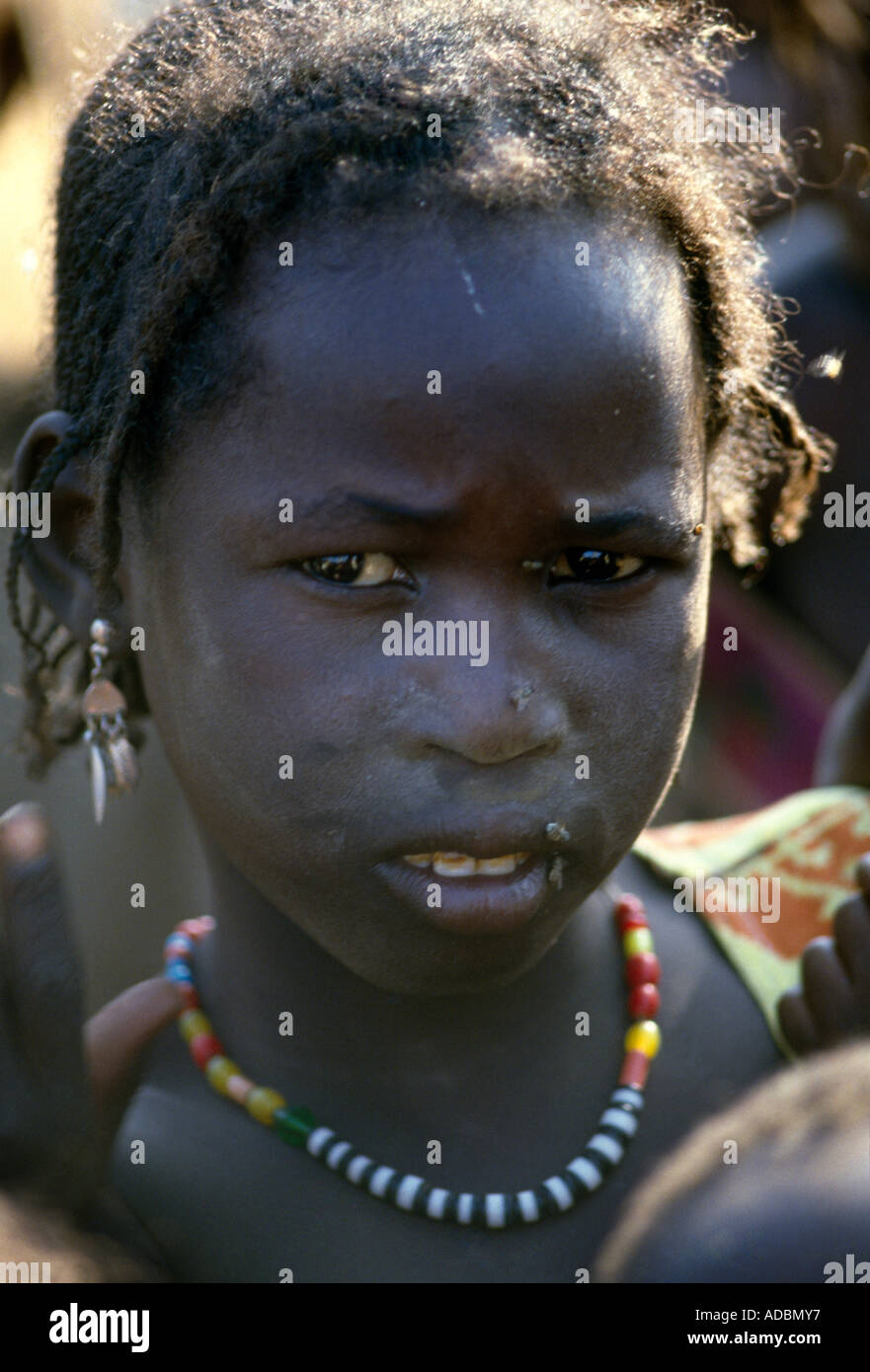 Sinnar Sudan Chadian Refugee With Flies On Face Kwashiorkor Stock Photo