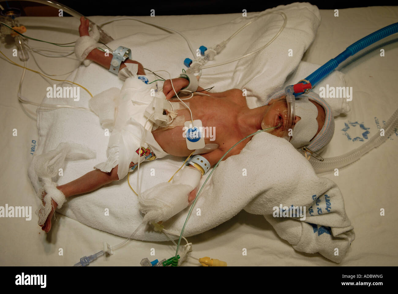 Premature infant at neonatal intensive care unit Stock Photo