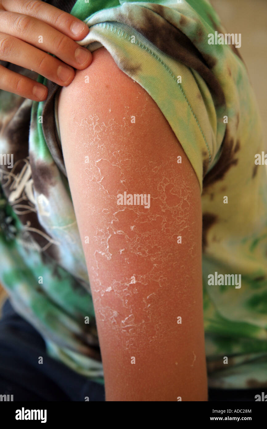 Boy showing his skin between the shoulder and elbow. He has burnt himsef in the sun and the skin is flakes off Stock Photo