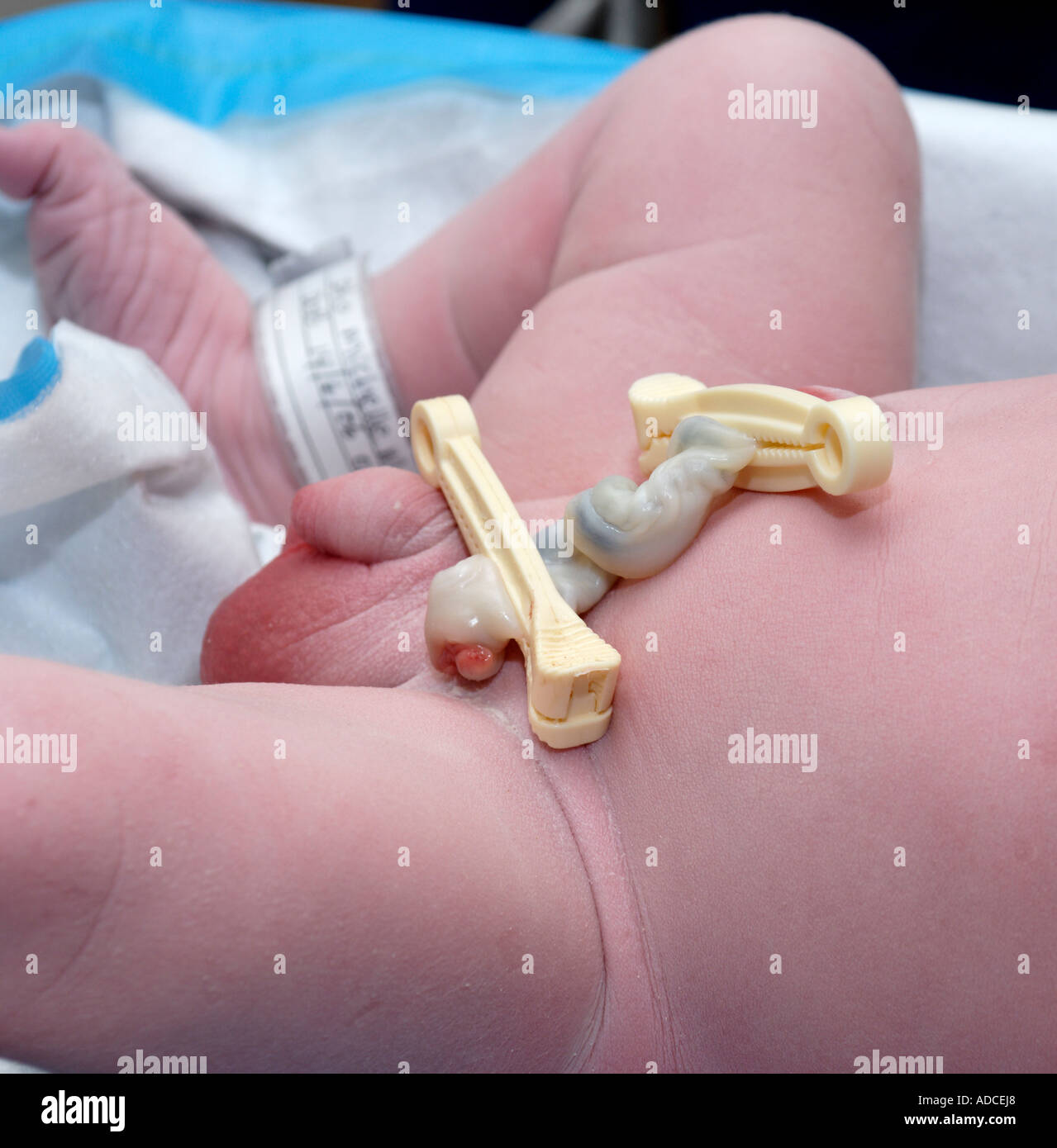 A close up of a newborn males umbilical cord with clamps in place just  after the cord had been cut Stock Photo - Alamy