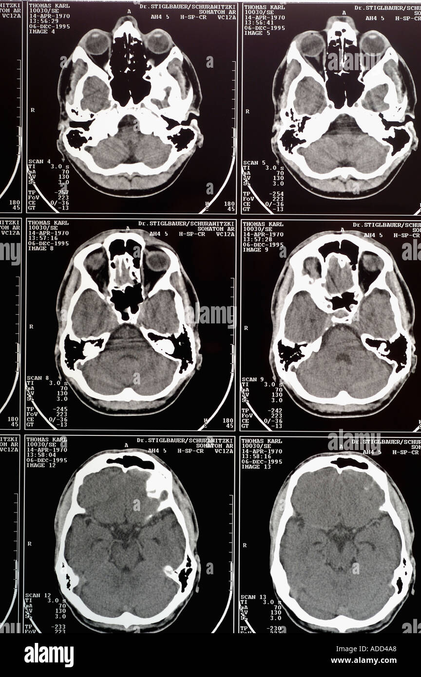 scan of human brain Stock Photo - Alamy