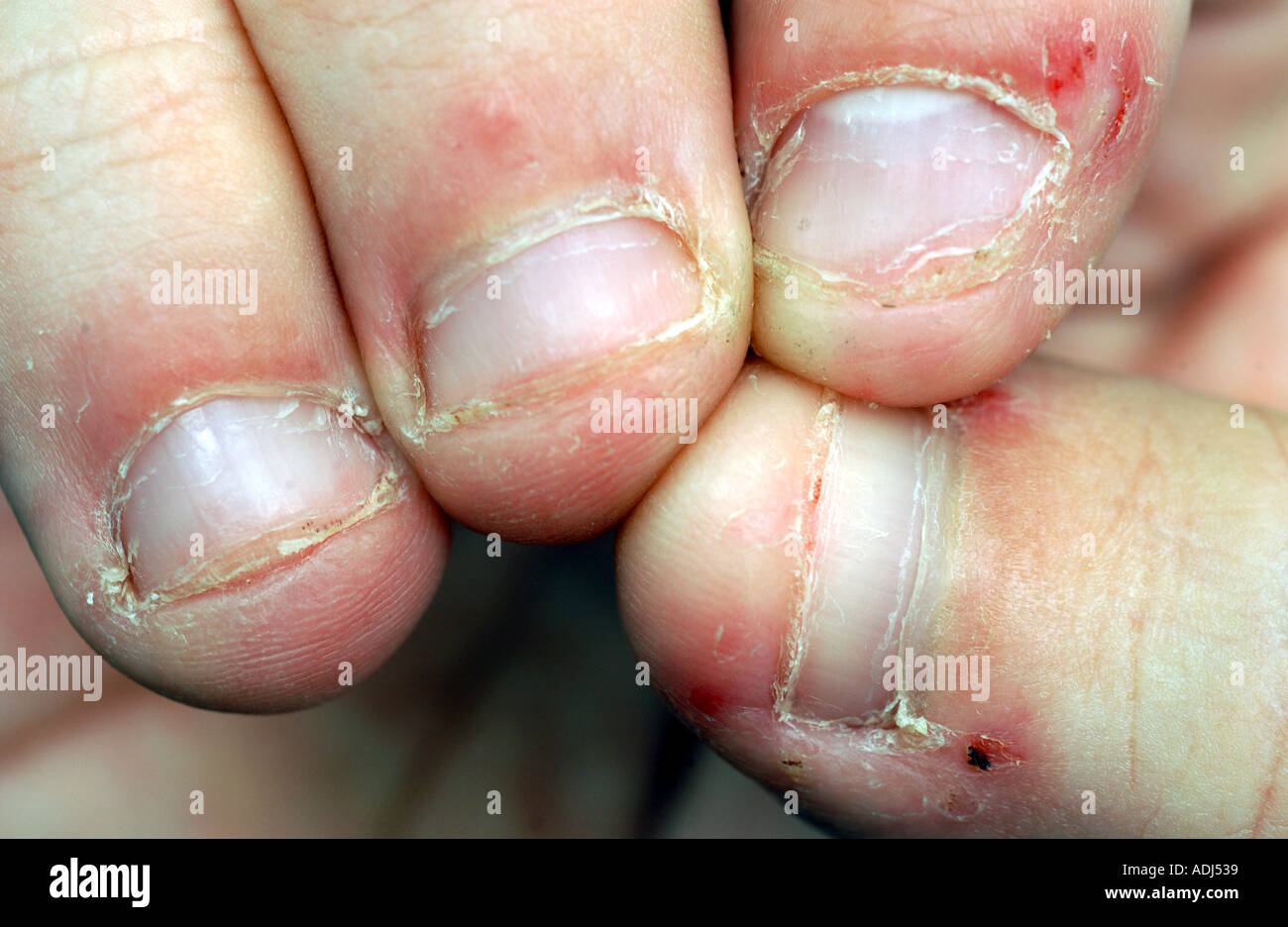 Share 132+ bitten nail extensions best songngunhatanh.edu.vn