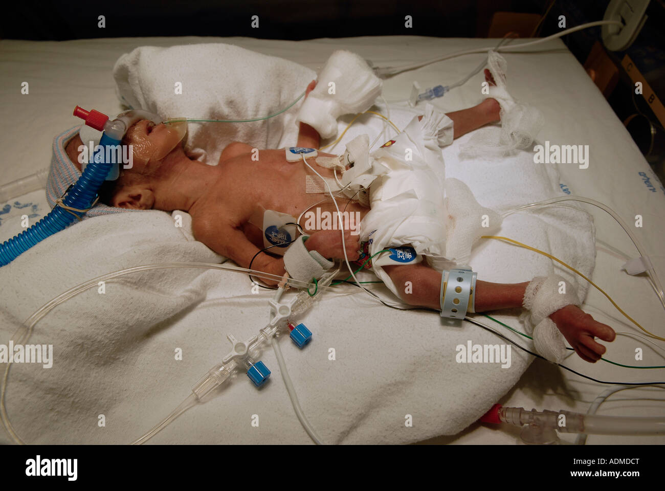 Premature baby at neonatal intensive care unit Stock Photo