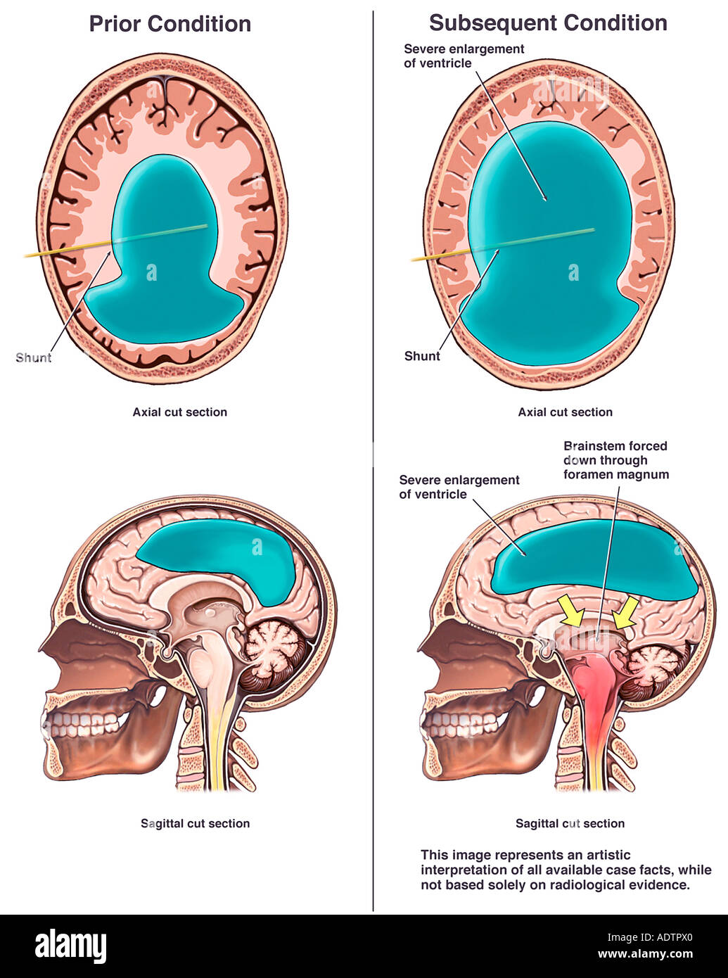 Hydrocephalus Vp Shunt