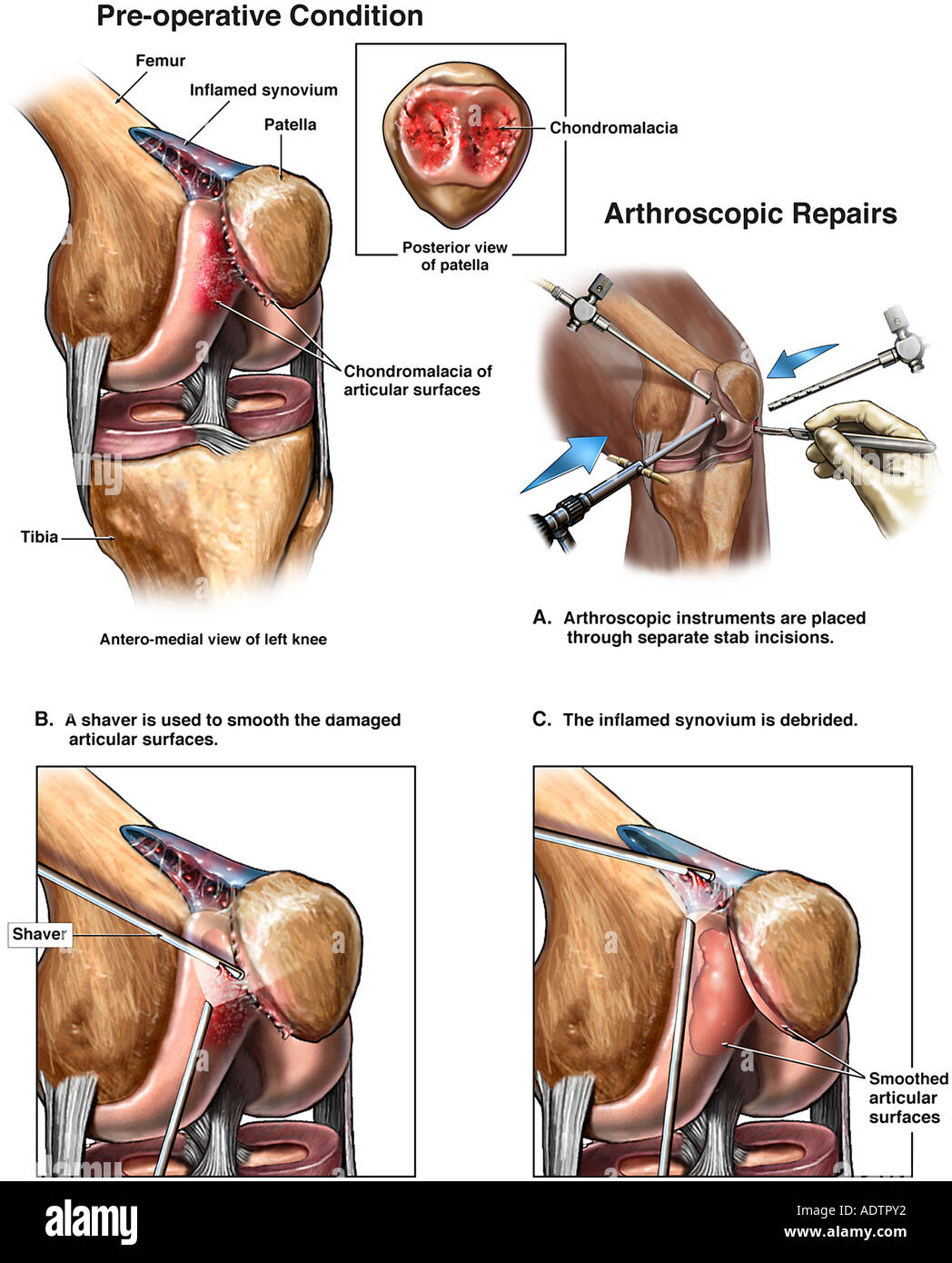 Knee Injury - Chondromalacia with Arthroscopic Repairs Stock Photo