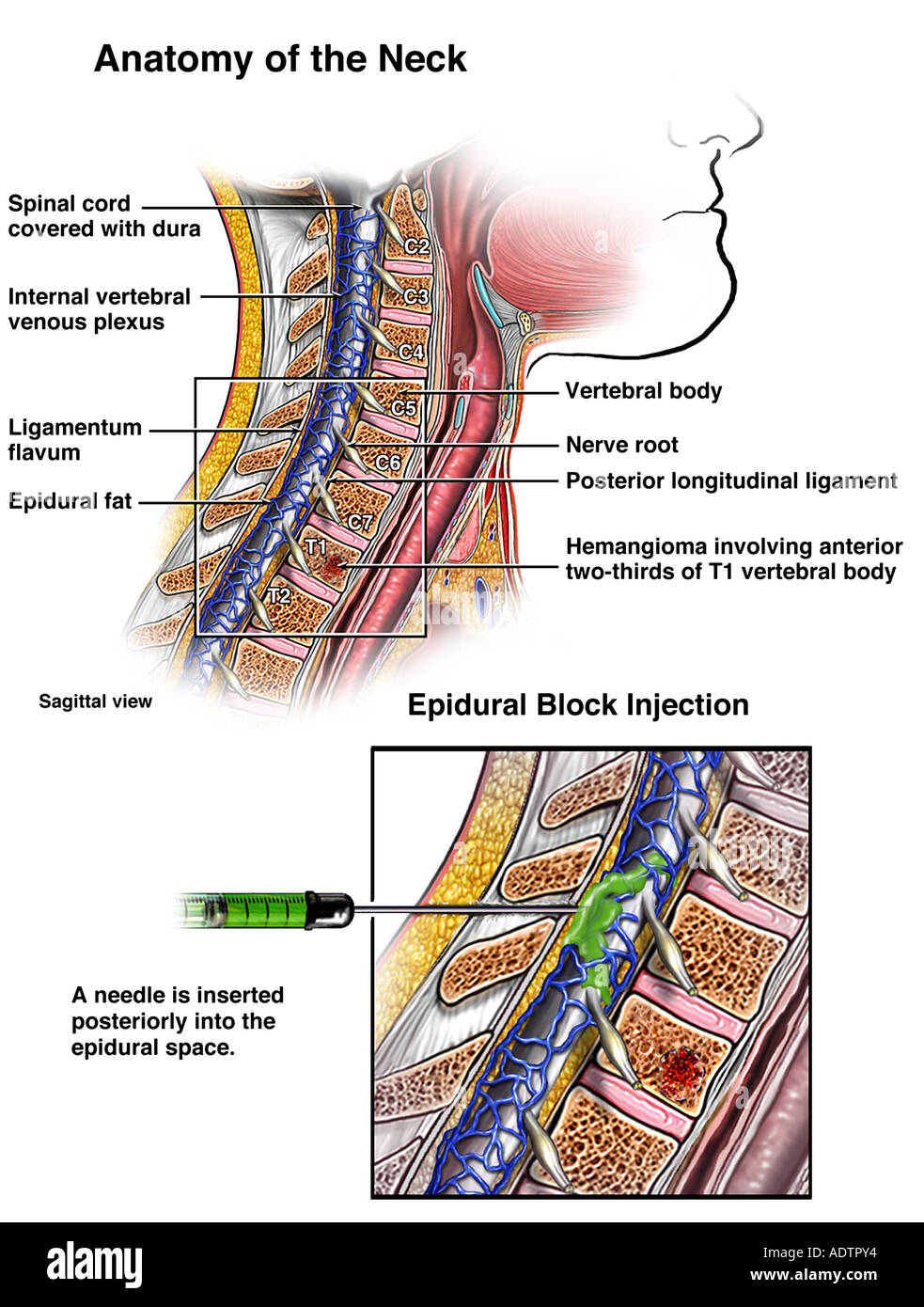 Injection Block Spinal nerve block hi-res stock photography and images - Alamy