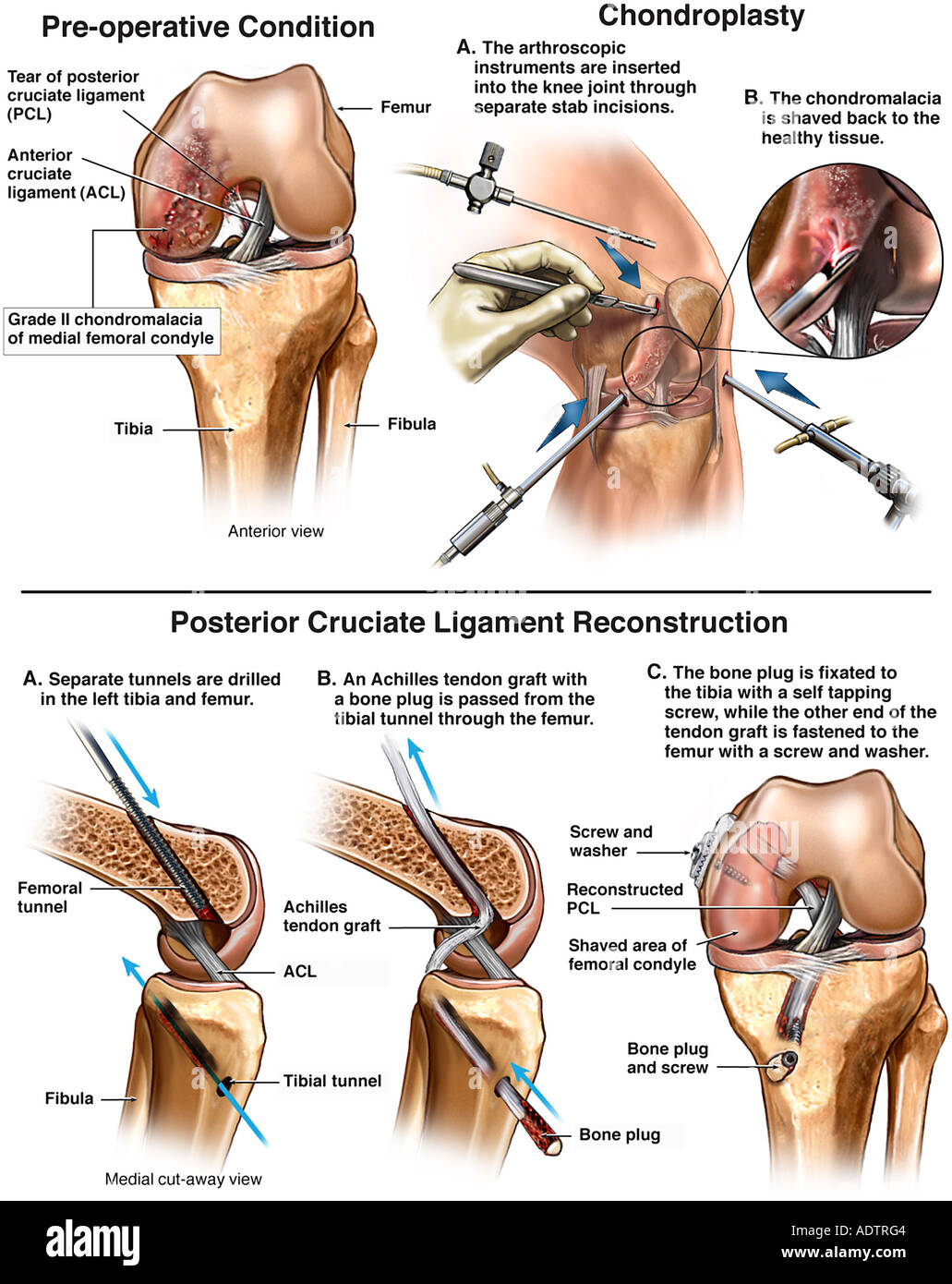 Tear of Posterior Cruciate Ligament with Surgical Repairs Stock Photo