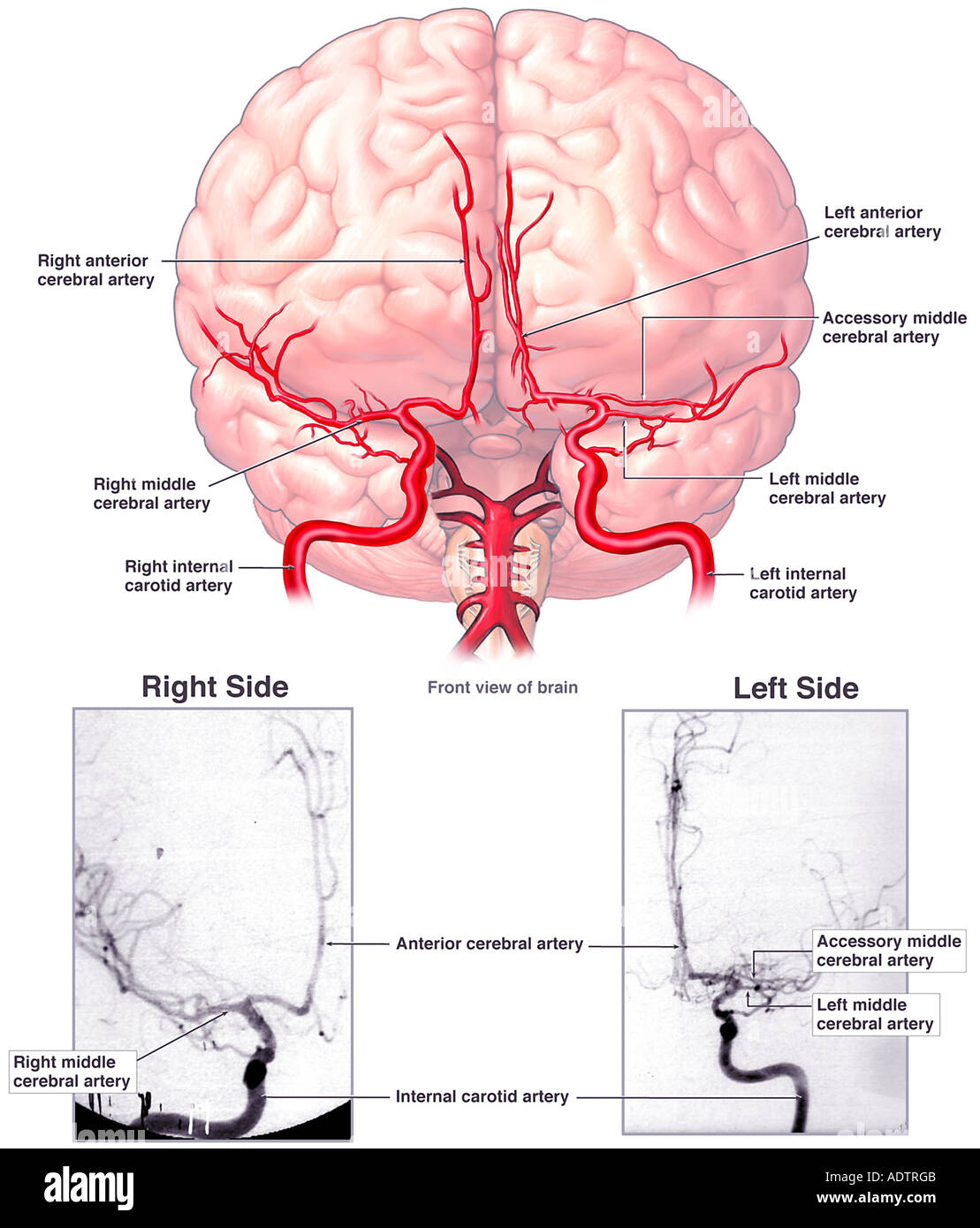 Cerebral Arteriograms Stock Photo