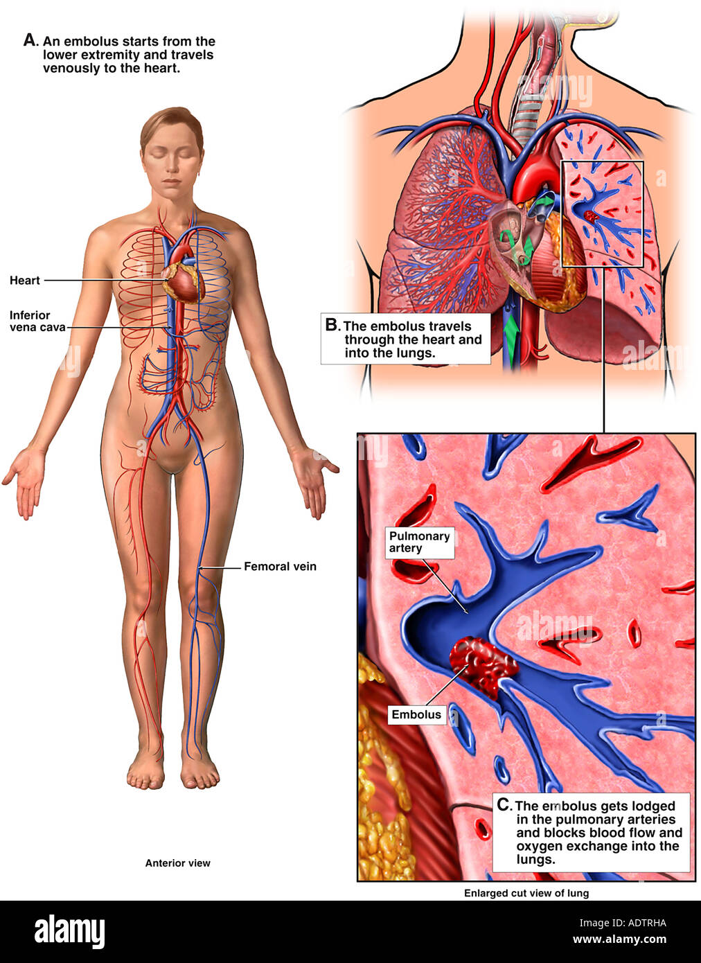 Mechanism of Pulmonary Embolism Stock Photo