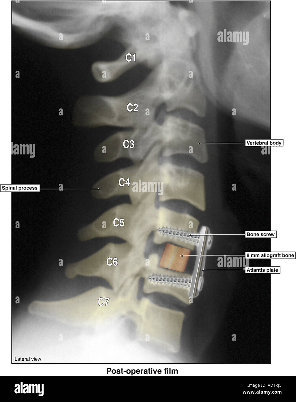 Anterior Cervical Discectomy and Fusion with Application of Atlantis Hardware Stock Photo