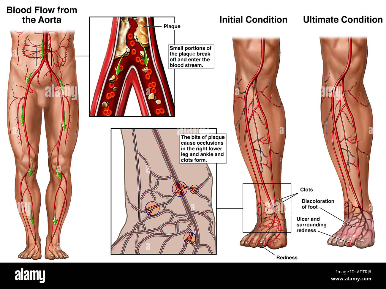 Progression Of Arterial Blockage In The Right Leg Stock Photo Alamy