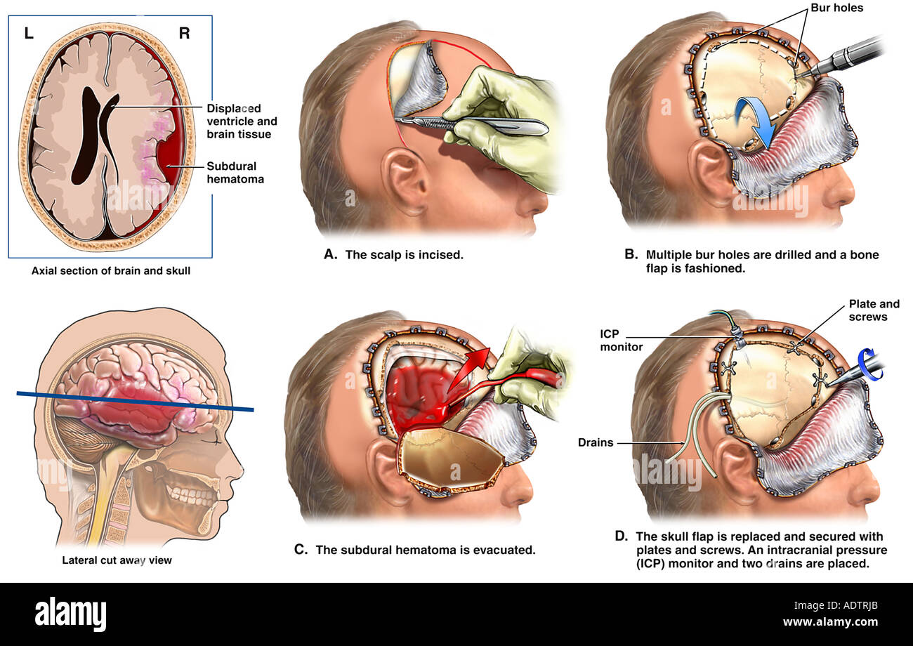 Brain Surgery - Severe Head Injury with Surgical Craniotomy Stock Photo